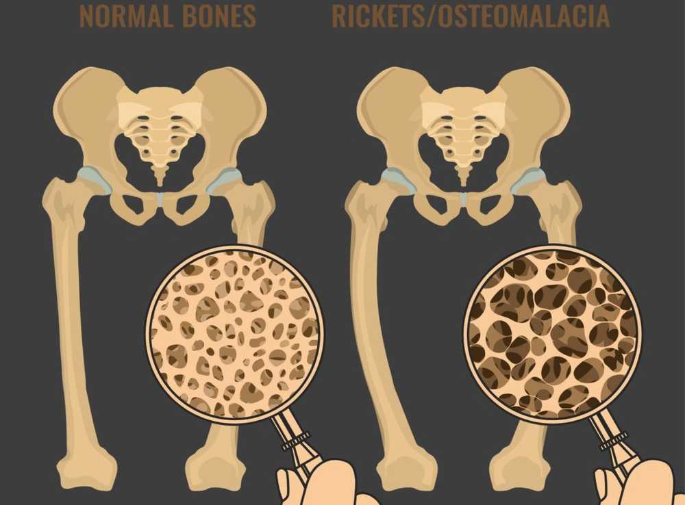 Bone softening - causes, symptoms and therapy / Diseases