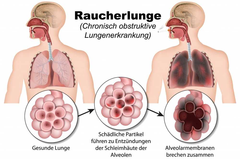 Contact met passief roken tijdens de kinderjaren verhoogt het latere COPD-risico / Gezondheid nieuws