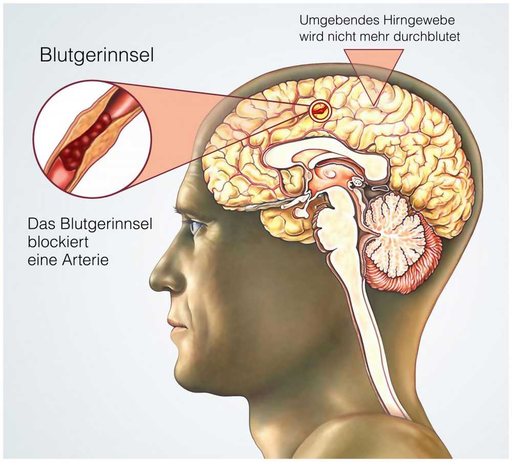 Low-cost patch has been shown to increase the survival rate in strokes / Health News