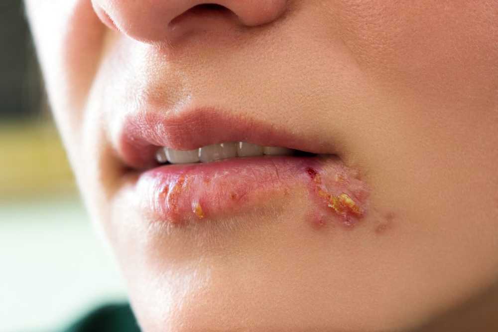 Fastidiosi herpes labiali Herpes trasferiti inosservati e per tutta la vita / Notizie di salute