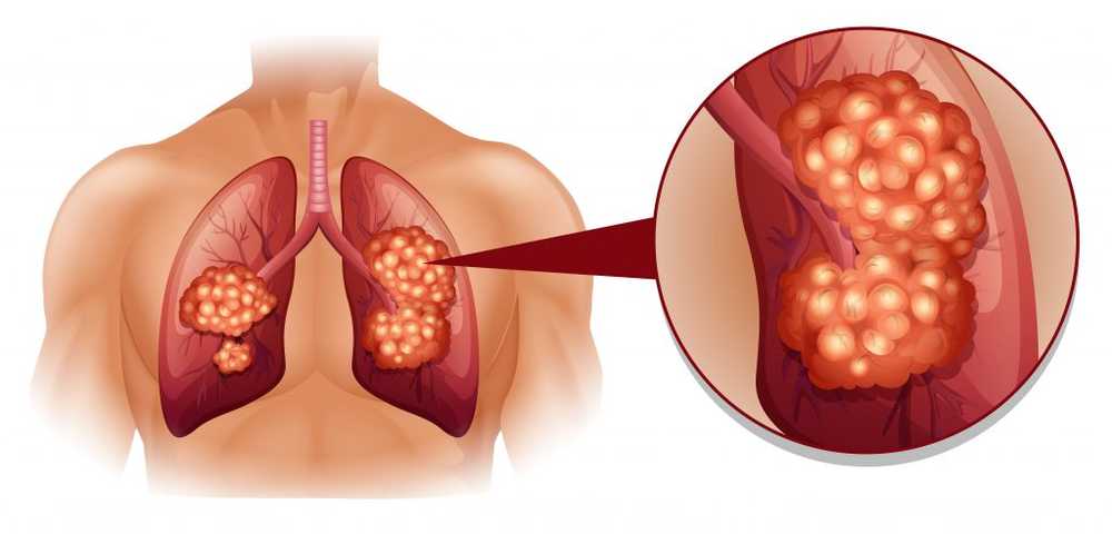 Lungtumörer utlöser lunghypertension / Hälsa nyheter