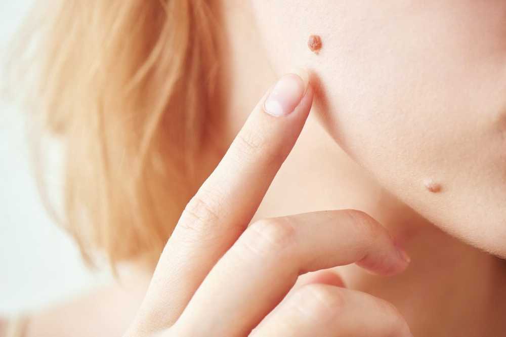 Birthmark Itches - Causes and Therapy