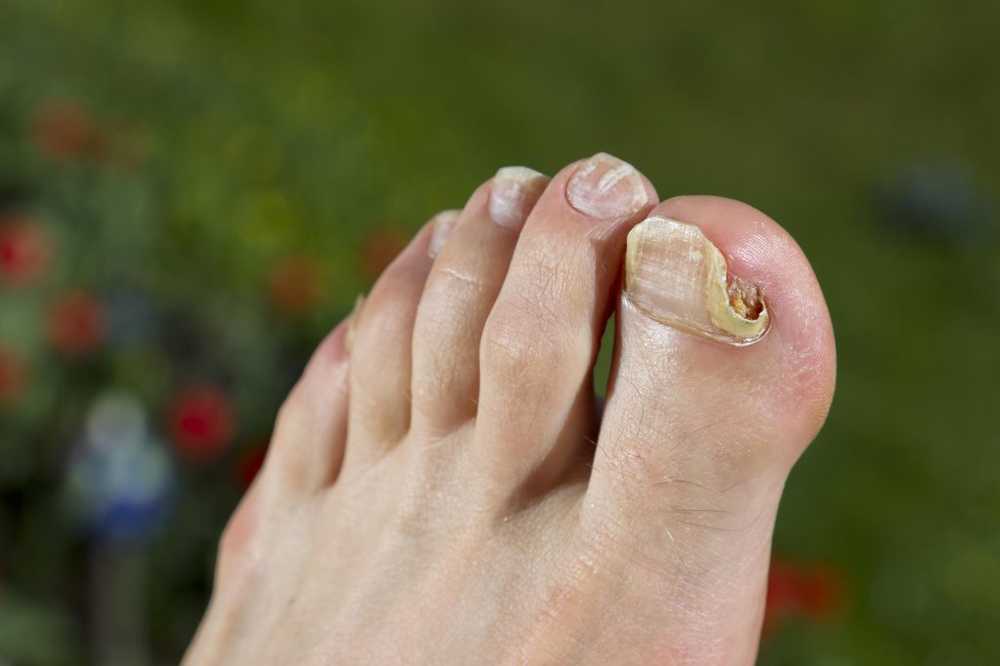 Nail Fungus - Causes, Symptoms, Home Remedies and Therapy