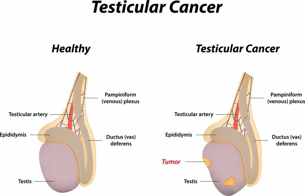 Nouă alternativă la chimioterapie? Tratamentul imunologic pentru cancerul testicular / Știri despre sănătate