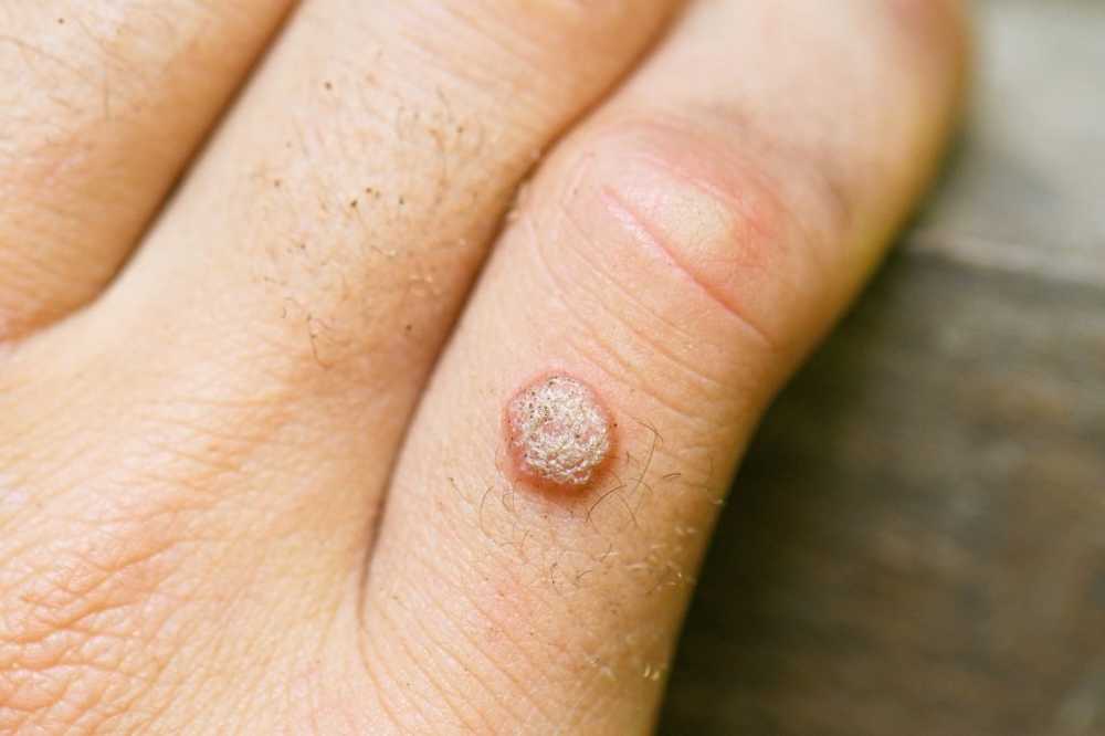 Never Pulen! Warts have no chance with these remedies / Health News