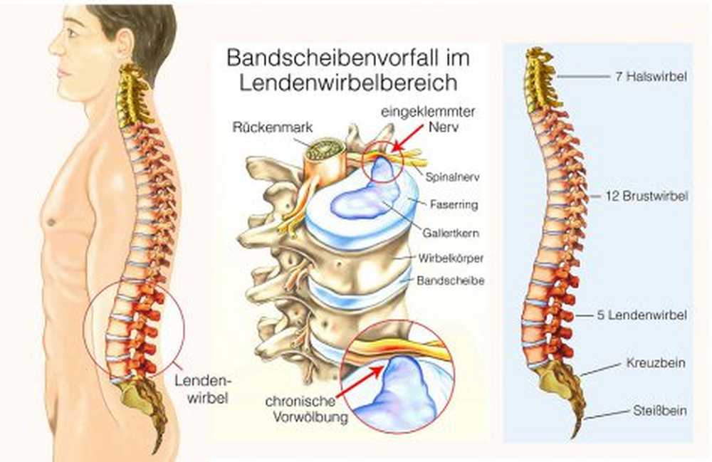 Ofte feil diagnostisk herniated disk eller ISG syndrom? / Helse Nyheter