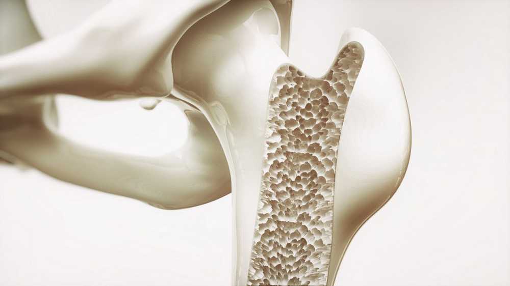 Prevent osteoporosis for life / Health News