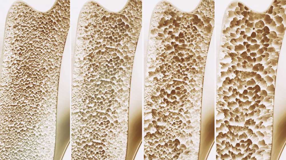 Ostéoporose - symptômes, causes et traitement