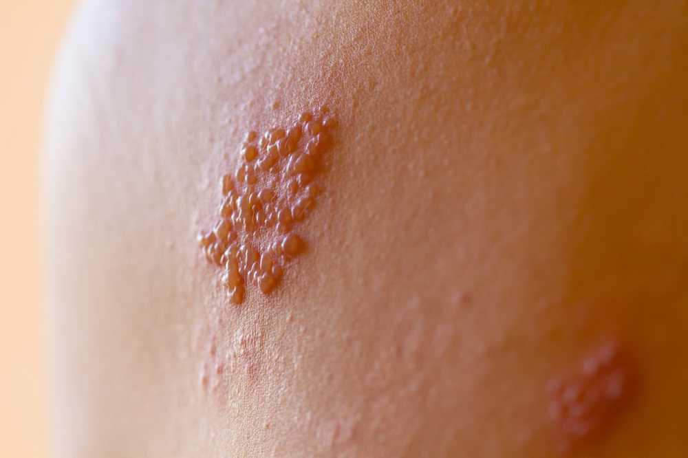 Papules symptoms, causes and treatment / symptoms