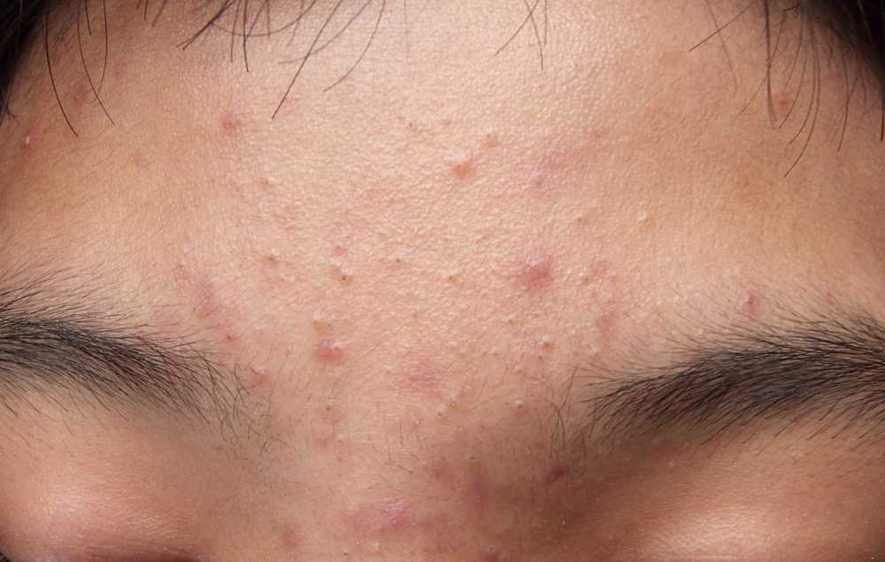 Pimples, blackheads og blemished skin Unngå disse matvarene for det meste / Helse Nyheter