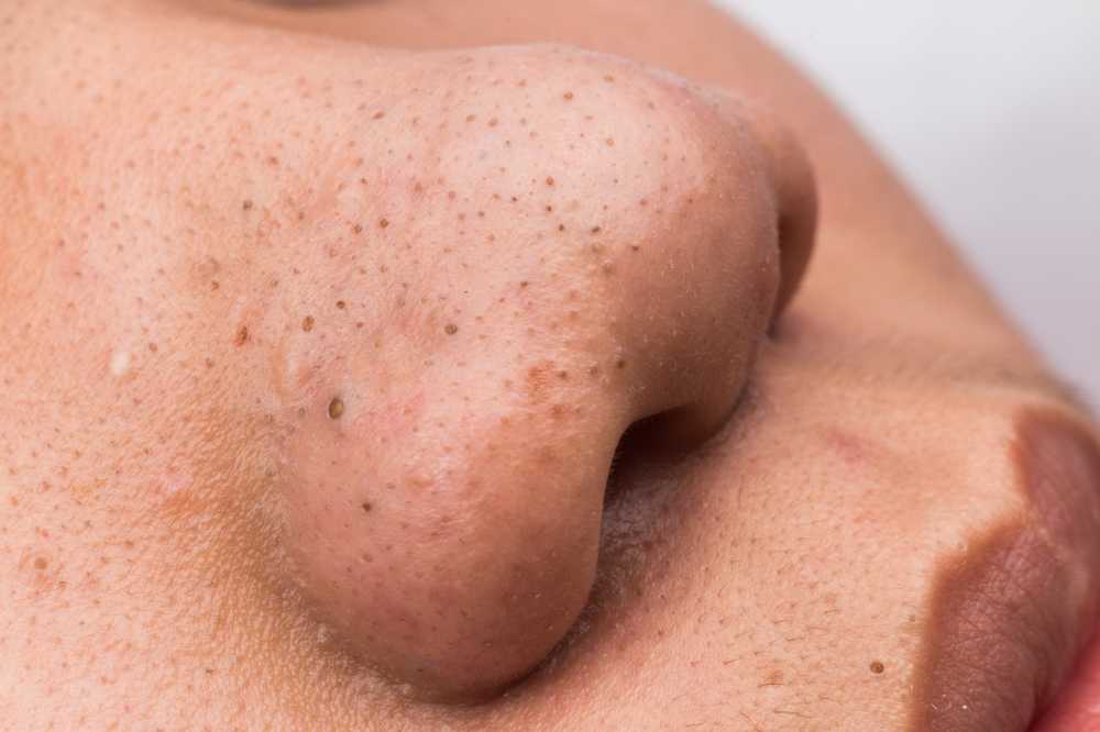 Pimple triggering Sometimes healthy causes triggers of impure skin / Health News