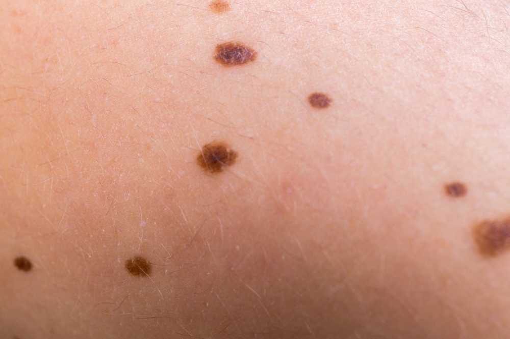 Pigment spots - causes and home remedies / symptoms