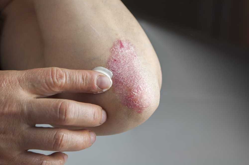 Psoriasis Over 2 million Germans suffer from psoriasis / Health News