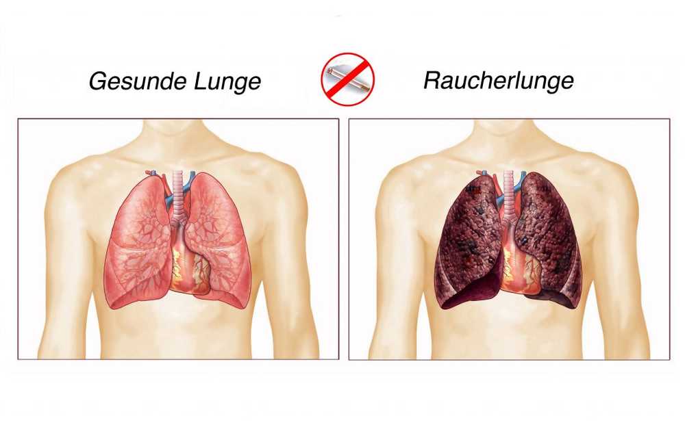 Poumon d'un fumeur (MPOC) - Symptômes, causes, thérapie