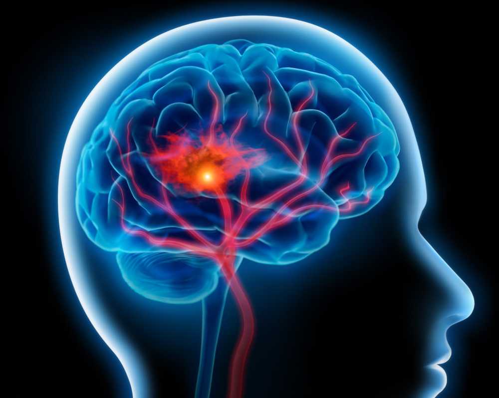 Risk Factors The risk of fatal cerebral hemorrhage is dramatically increased by high blood pressure & smoking / Health News