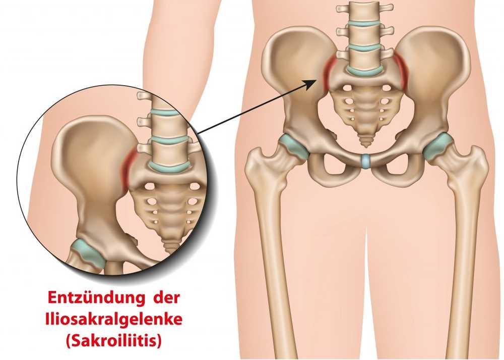 boala articulației sacroiliace ce să faci cu durerea în articulațiile picioarelor
