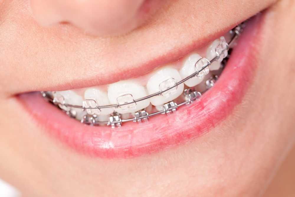 Crooked teeth Wat kan permanent helpen? / Gezondheid nieuws