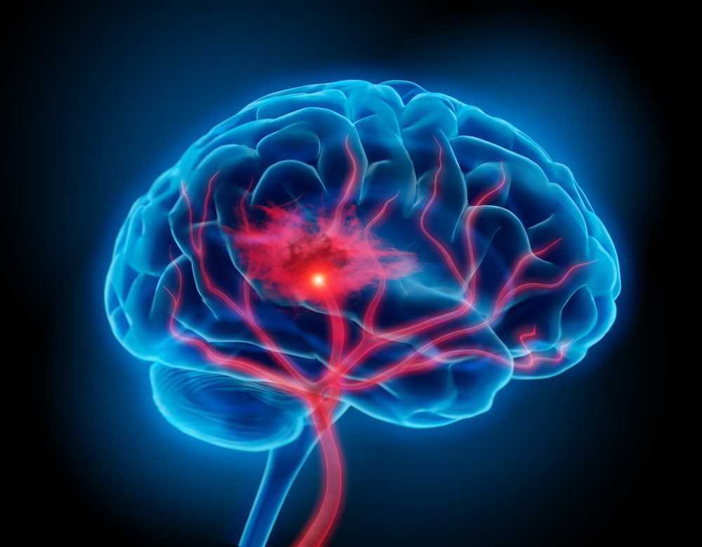 Stroke Identified previously unknown risk factors / Health News