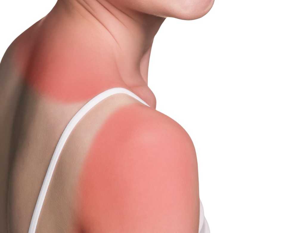 Painful sunburn Yoghurt, Quark and ASA relieve the symptoms / Health News