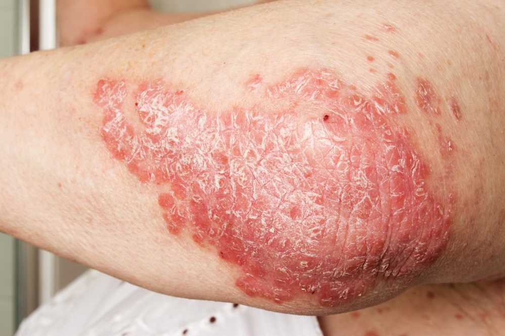 Psoriasis - causes and treatment