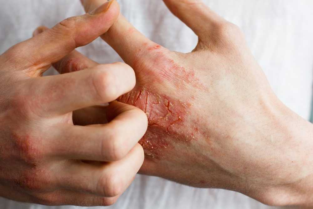 Skalete hud - årsaker og behandling