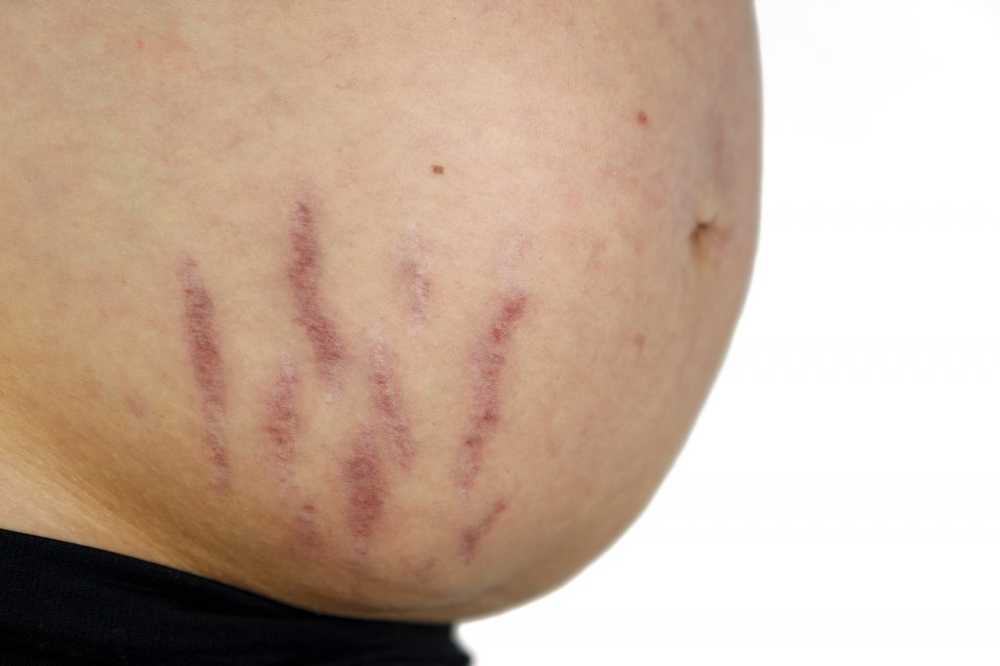 Stretch marks - Causes, Treatment and Prevention