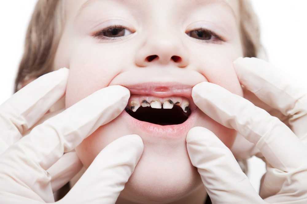 Rare visits to the dentist lead to significantly more distance from teeth in children / Health News