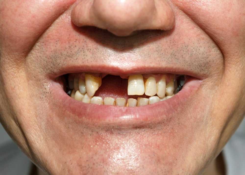 SOS consejos sobre la pérdida de dientes. / Noticias de salud