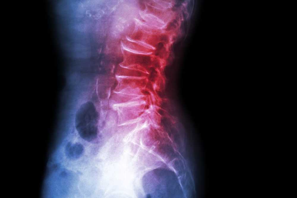 Spondylolisthésis - symptômes, causes et traitement