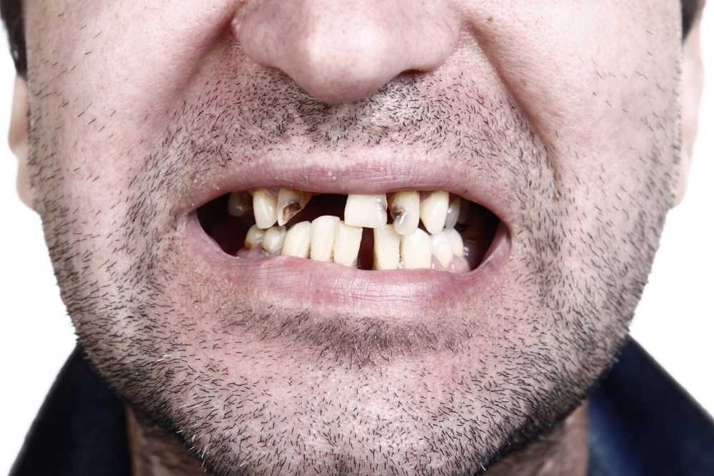 Studere hvordan karies-forårsakende bakterier overlever i dental plakett