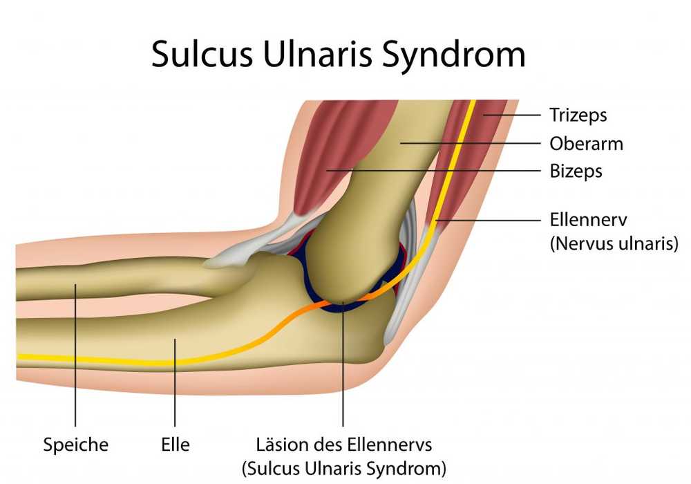 Sulcus ulnar eller cubitaltunnelsyndrom / sjukdomar