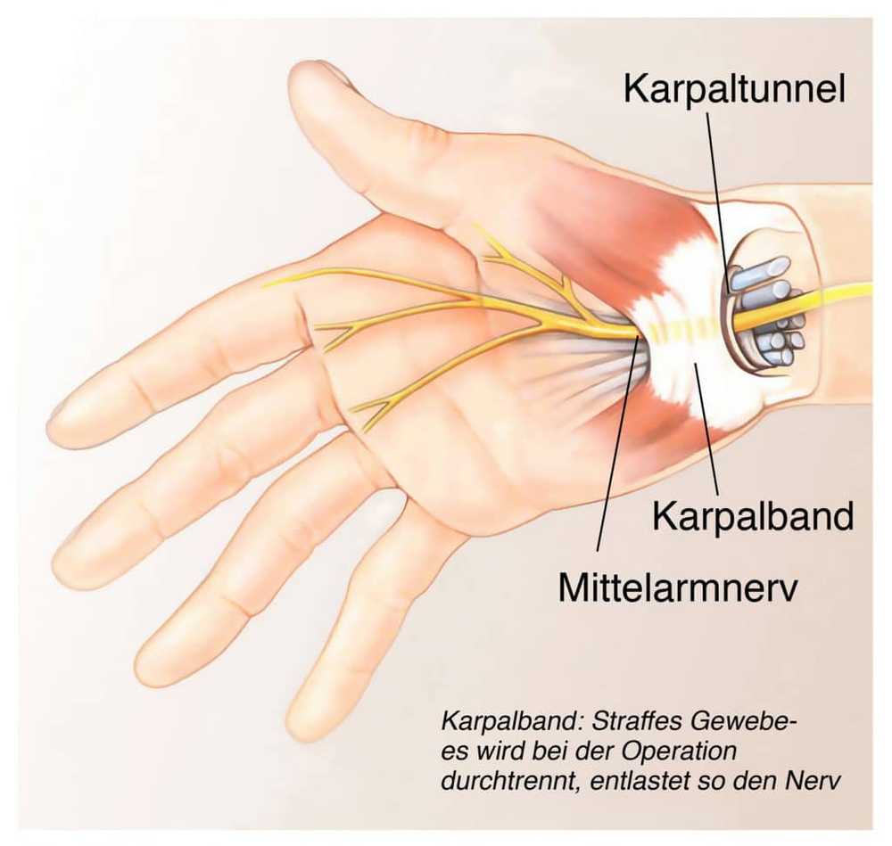 TCM bestudeert electro-acupunctuur, effectief bij carpaal tunnel syndroom / Gezondheid nieuws