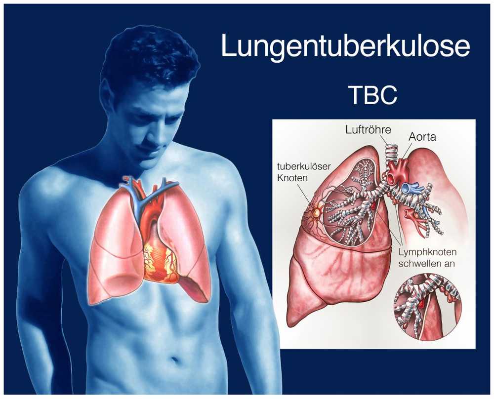 Tuberculoseziekten blijven hoog in Duitsland / Gezondheid nieuws