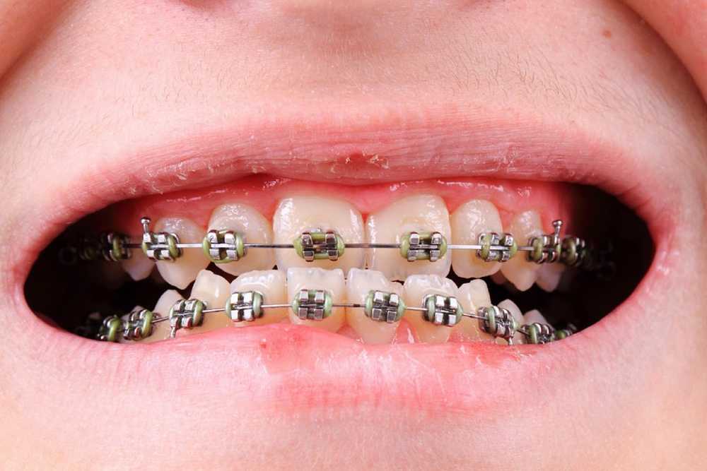 Når er det nødvendig med braces? / Helse Nyheter