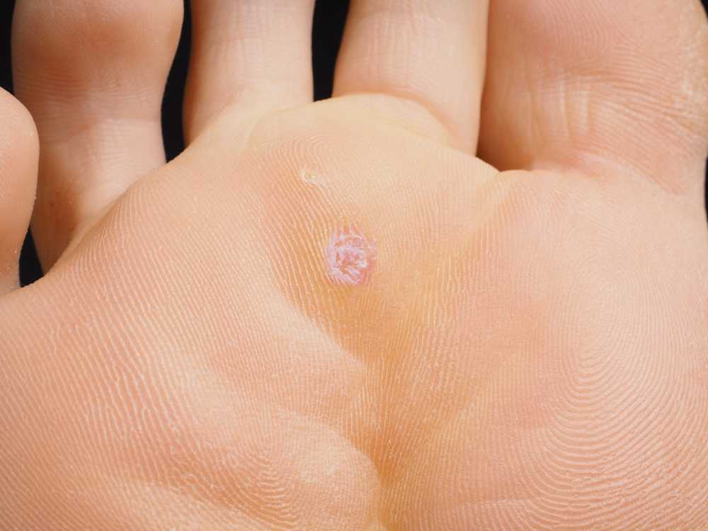 What promotes warts education That can help / Health News