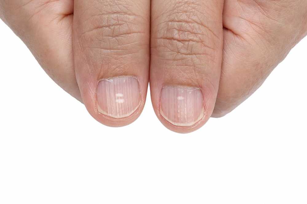 Vita fläckar eller färgning av naglarna kan bero på sjukdomar / Hälsa nyheter