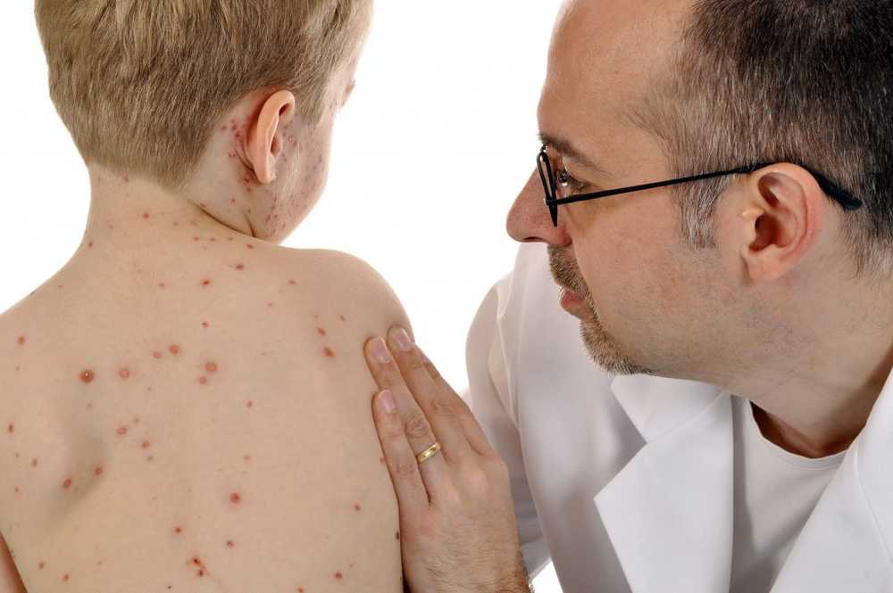 La varicella negli Stati Uniti causa gli oppositori del vaccino / Notizie di salute