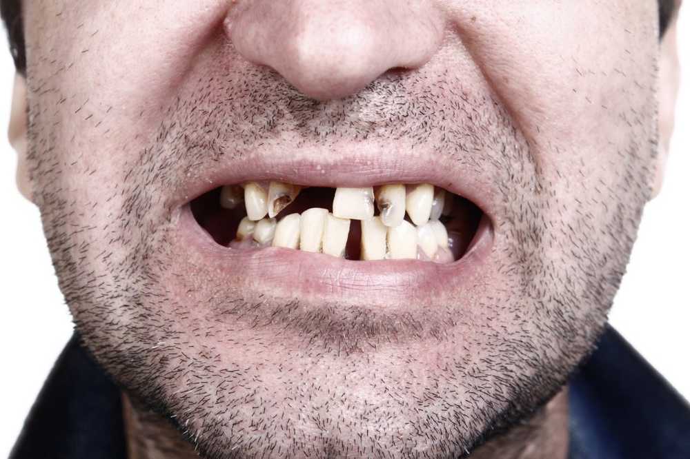 Tandongeval zoals in Mario Götze Hoe artsen tanden sparen na sportongelukken / Gezondheid nieuws
