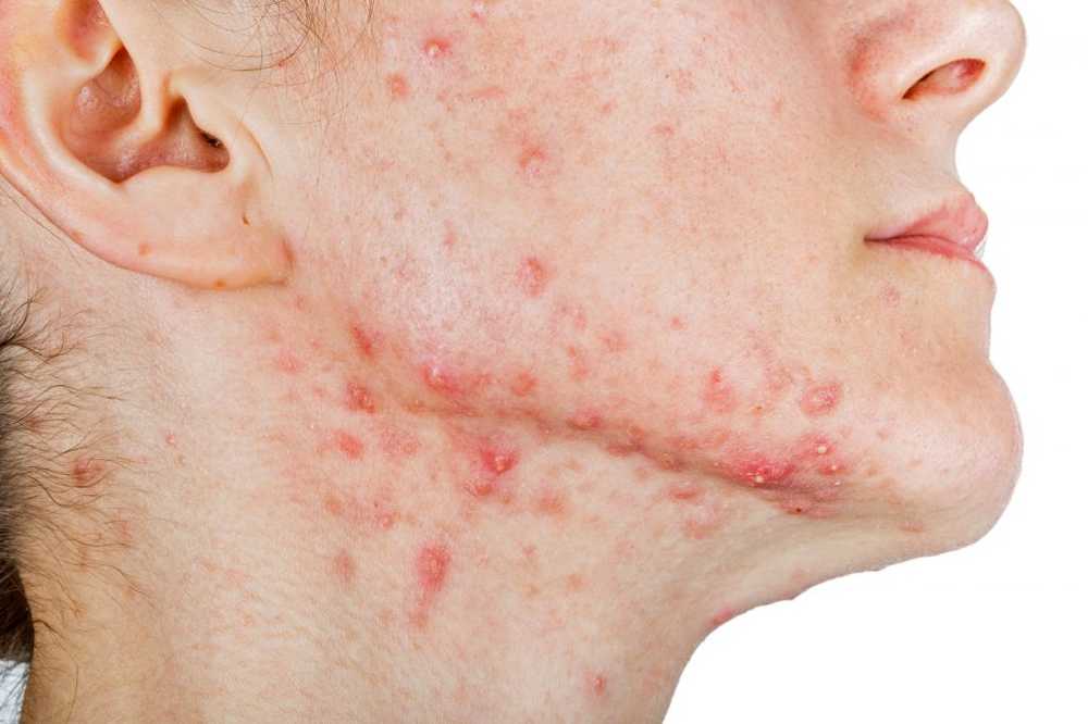 Acne with over 30 Why pimples better not be expressed / Health News