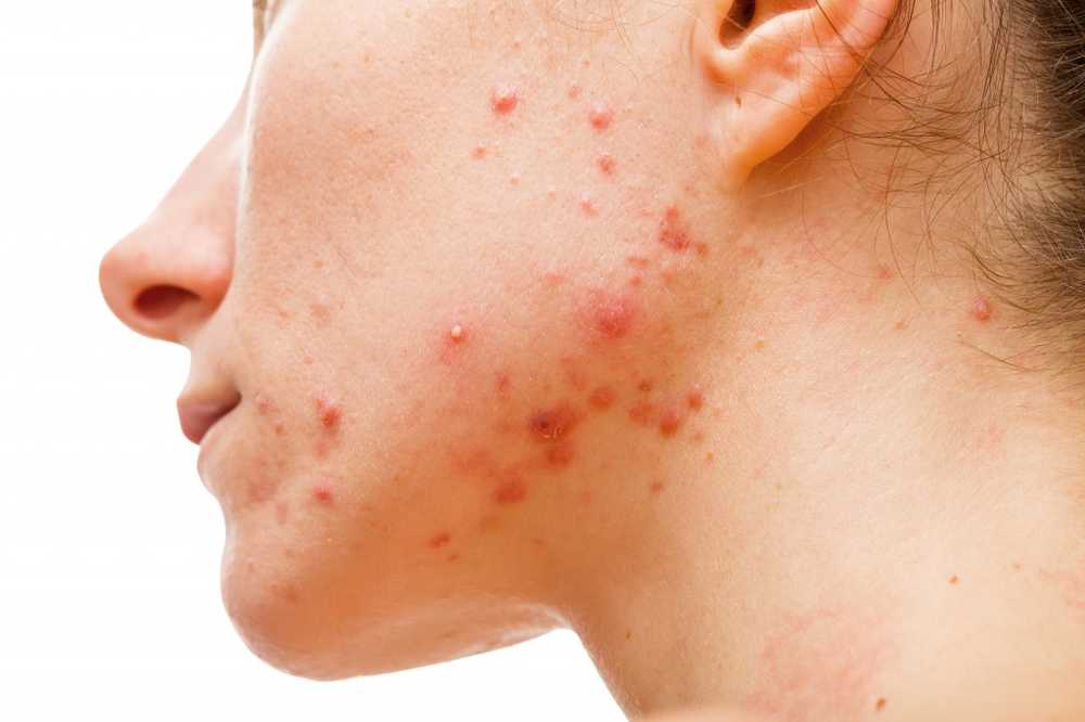 Never apply acne pimple plaster on injured skin / Health News