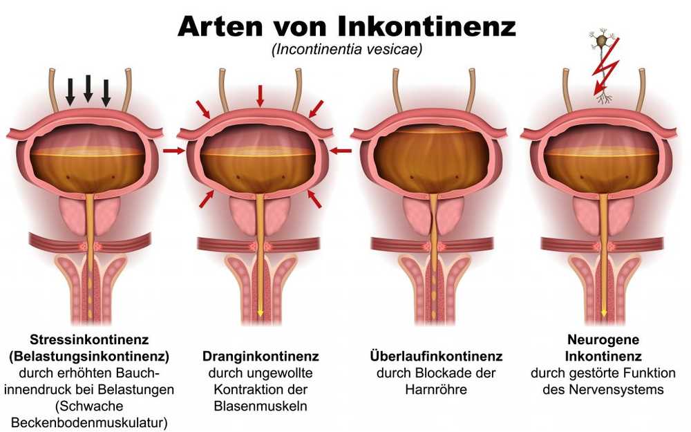 Linee guida aggiornate sull'incontinenza urinaria nei pazienti geriatrici / Notizie di salute