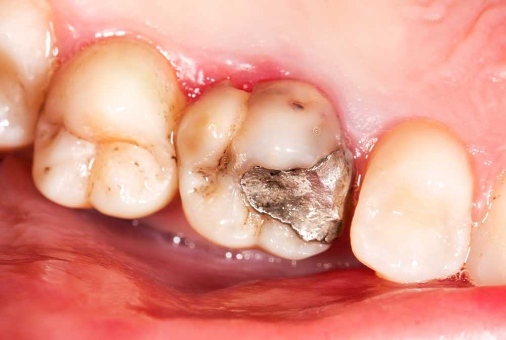 Amalgam Allergy Symptoms and Treatment / Diseases