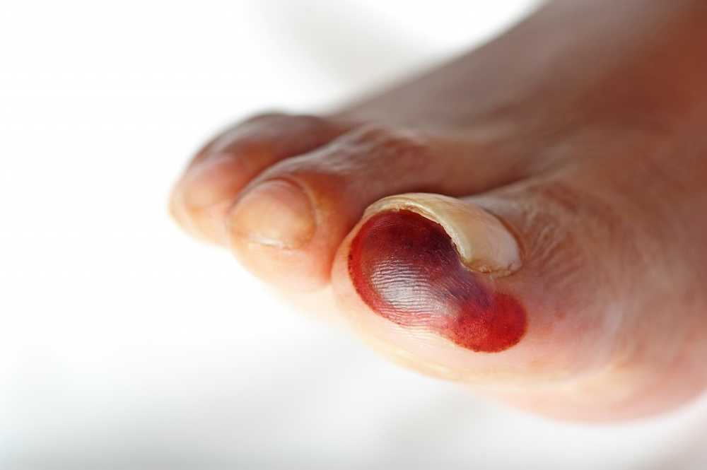 Amputations can be avoided - In case of diabetes consider the feet / Health News