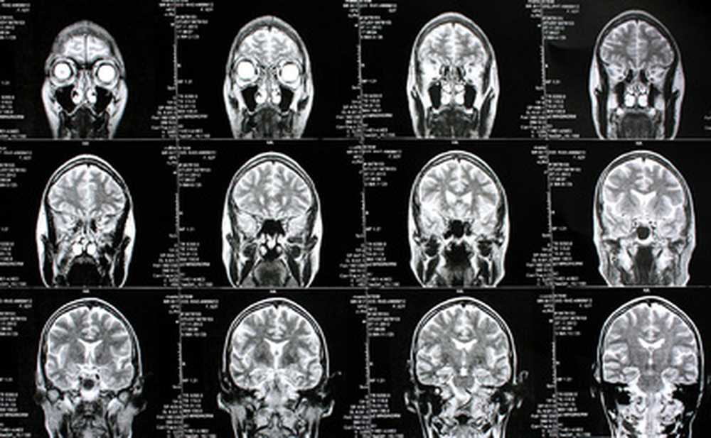 amyloidosis / Diseases