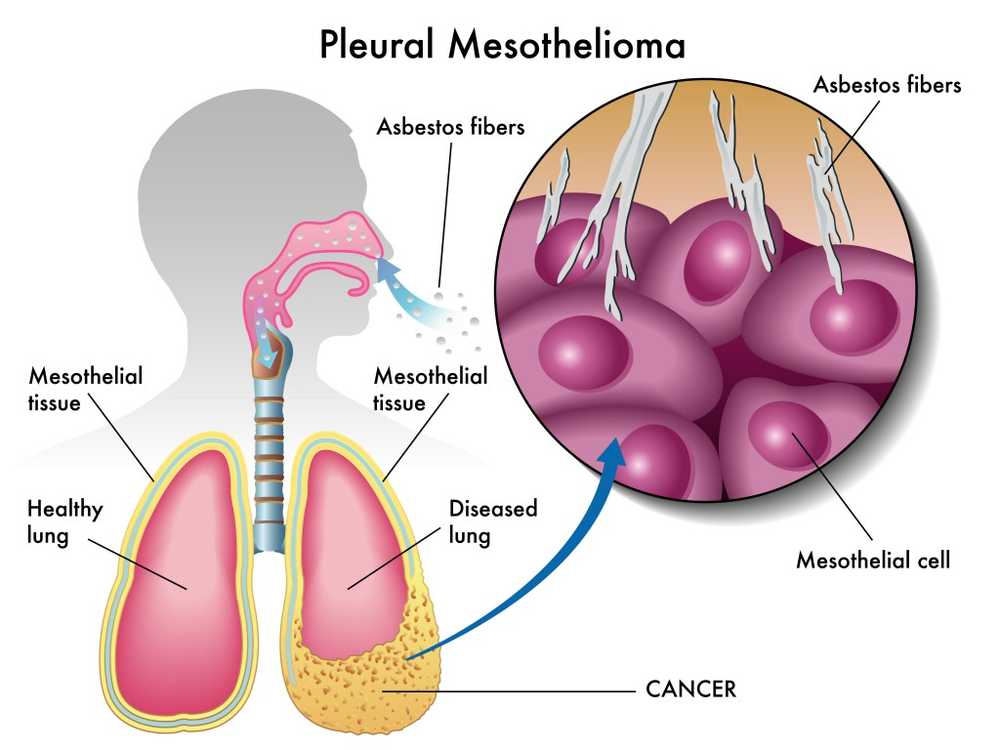 Augmentation des nouveaux cas de cancer à Achim, en Basse-Saxe / Nouvelles sur la santé