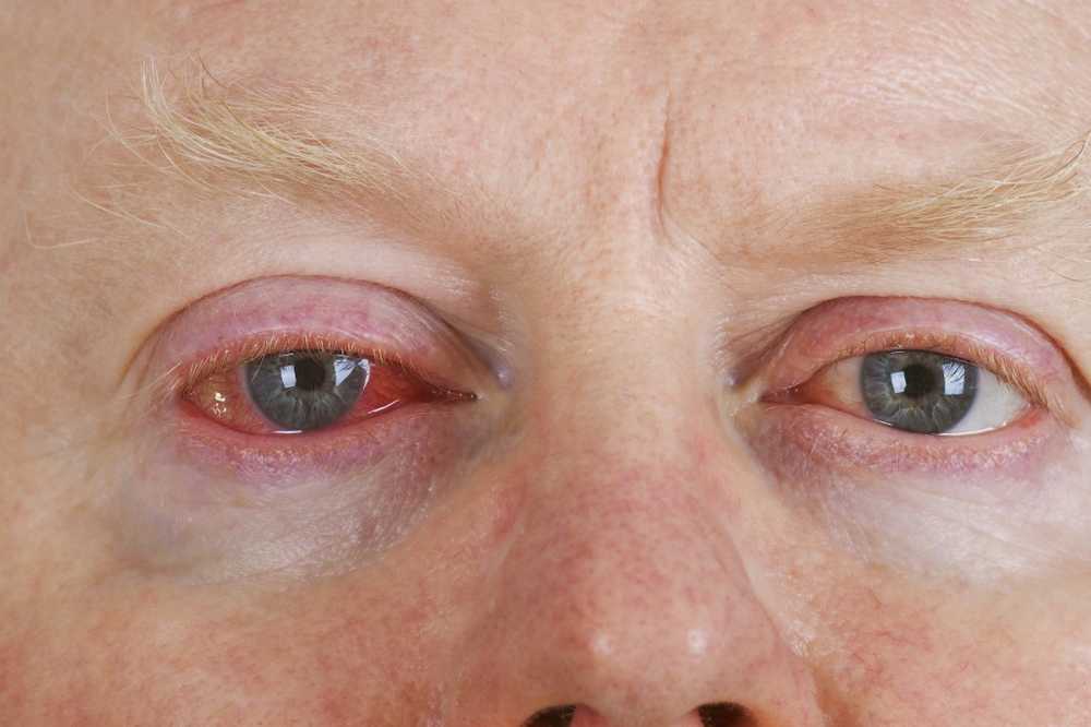 Behandeling van conjunctivitis / Gezondheid nieuws