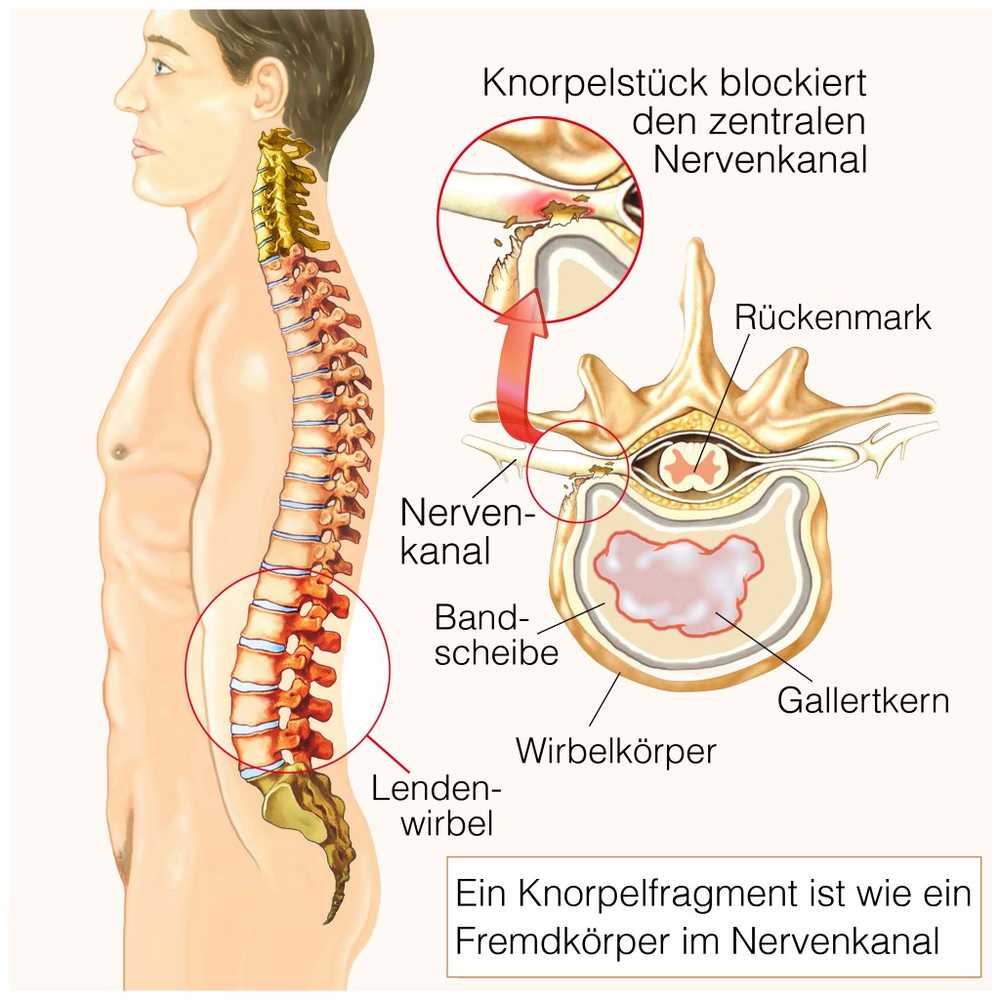 Traitements pour une hernie discale / Nouvelles sur la santé