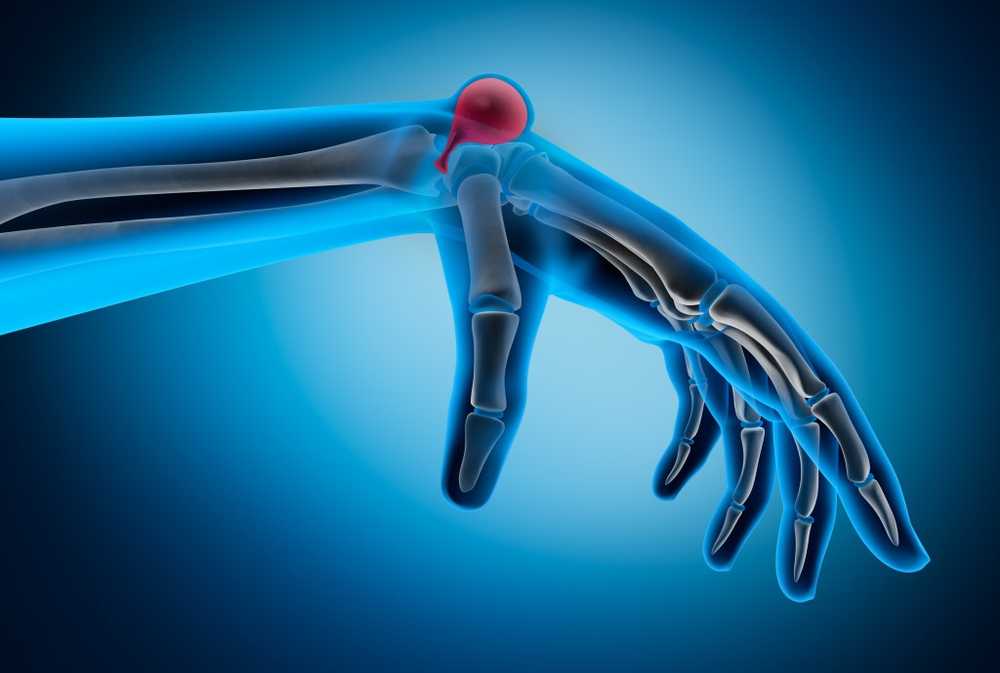 Piciorul de pe încheietura mâinii Ce să faci cu un ganglion / Știri despre sănătate