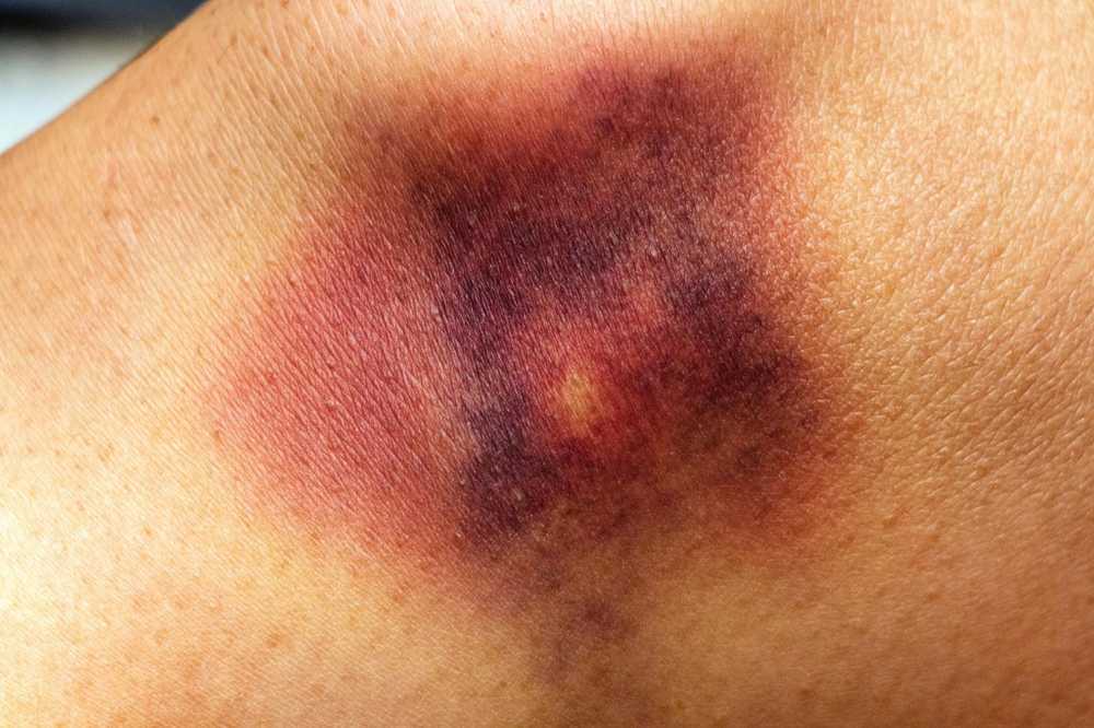 Blue spots Which hematomas are harmless and which have to be assessed / Health News