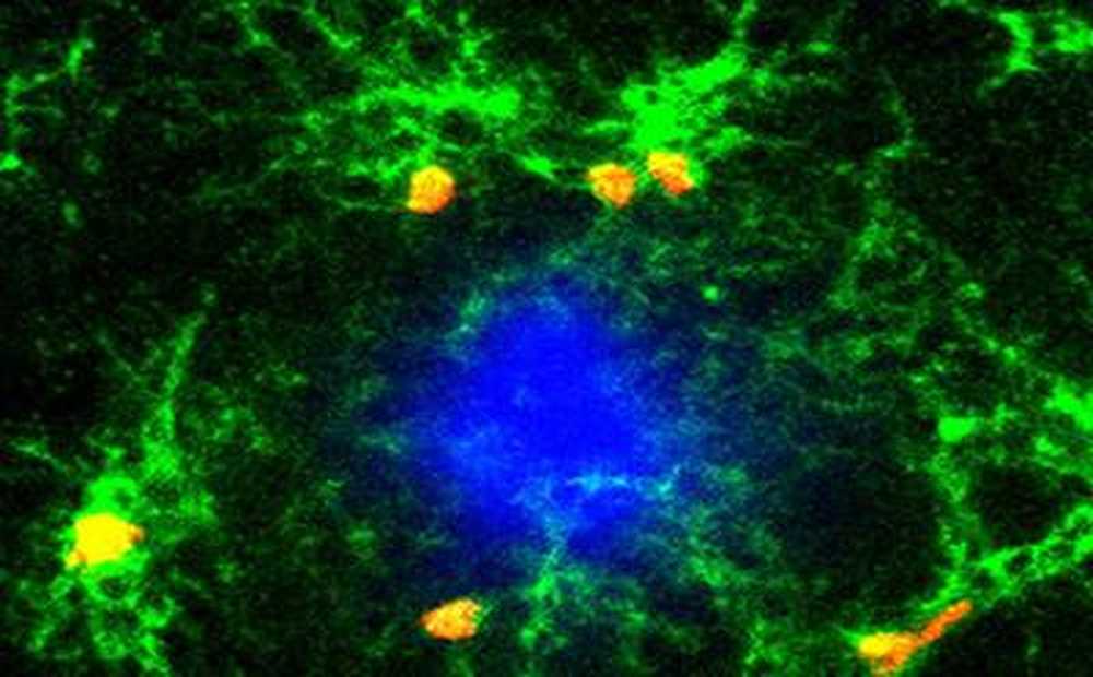 Blocking inflammation in the brain prevents progression of Alzheimer's / Health News